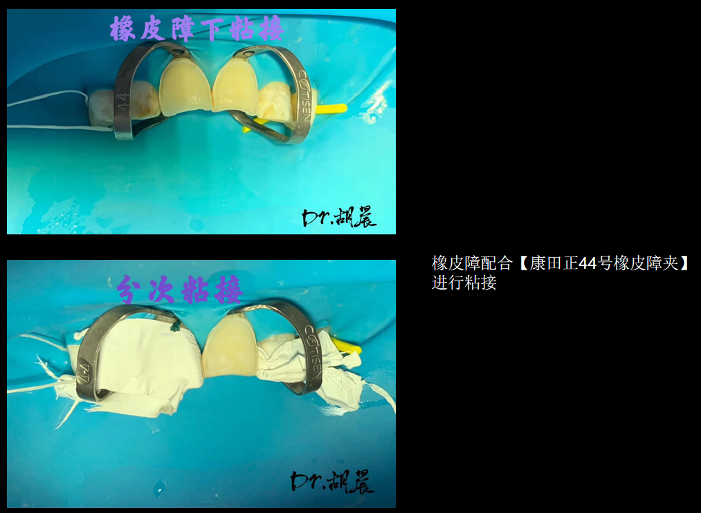 为什么牙医不用开口器特邀牙医【实操病例】集锦{9.22}_https://www.jmylbn.com_新闻资讯_第5张