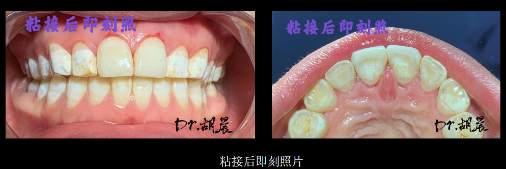 为什么牙医不用开口器特邀牙医【实操病例】集锦{9.22}_https://www.jmylbn.com_新闻资讯_第6张