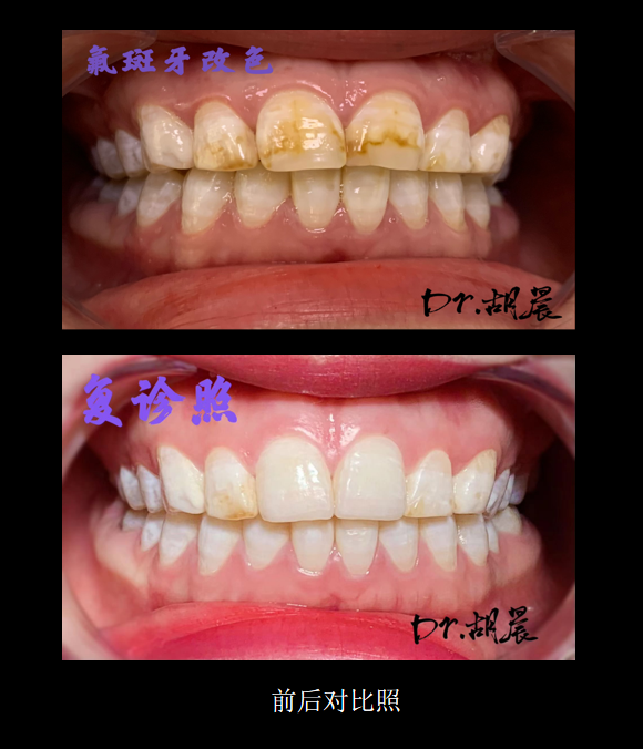 为什么牙医不用开口器特邀牙医【实操病例】集锦{9.22}_https://www.jmylbn.com_新闻资讯_第8张