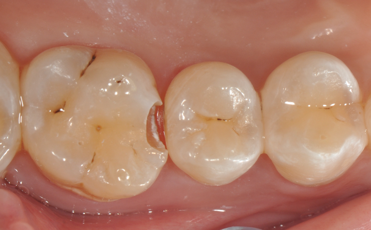 为什么牙医不用开口器特邀牙医【实操病例】集锦{9.22}_https://www.jmylbn.com_新闻资讯_第21张