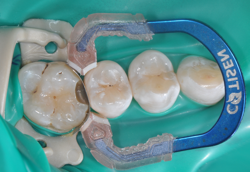 为什么牙医不用开口器特邀牙医【实操病例】集锦{9.22}_https://www.jmylbn.com_新闻资讯_第29张