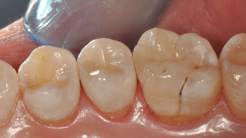 为什么牙医不用开口器特邀牙医【实操病例】集锦{9.22}_https://www.jmylbn.com_新闻资讯_第35张