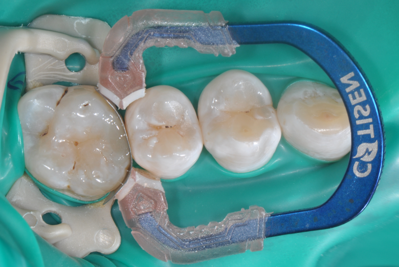 为什么牙医不用开口器特邀牙医【实操病例】集锦{9.22}_https://www.jmylbn.com_新闻资讯_第31张