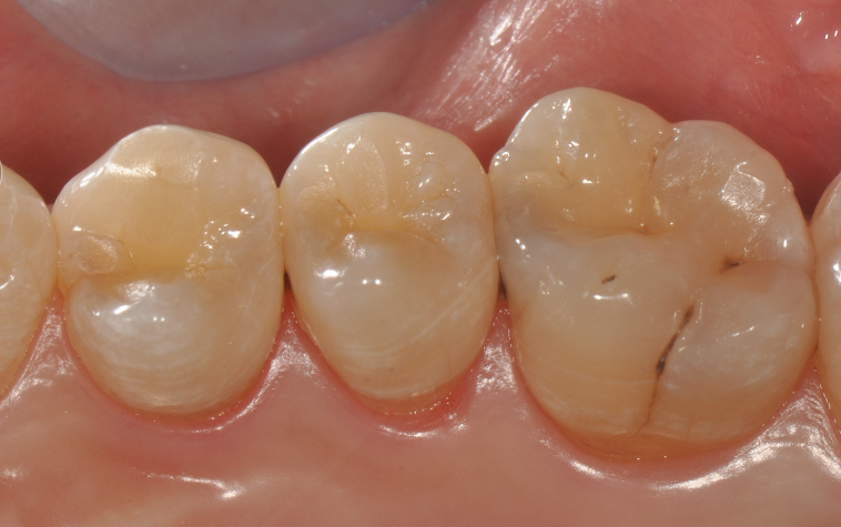 为什么牙医不用开口器特邀牙医【实操病例】集锦{9.22}_https://www.jmylbn.com_新闻资讯_第18张