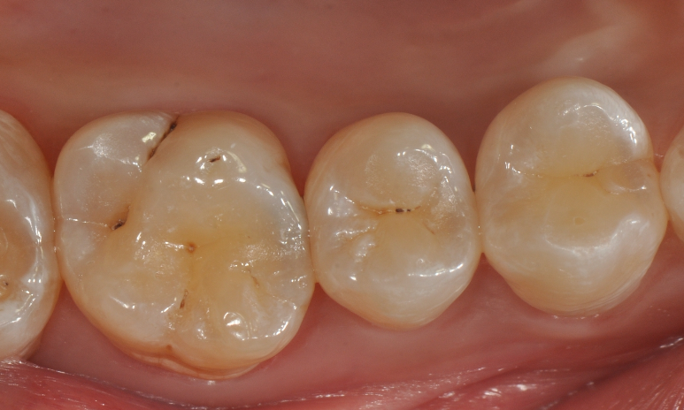 为什么牙医不用开口器特邀牙医【实操病例】集锦{9.22}_https://www.jmylbn.com_新闻资讯_第19张