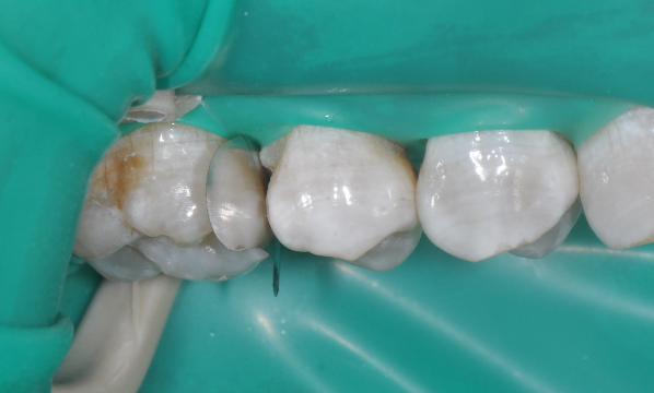 为什么牙医不用开口器特邀牙医【实操病例】集锦{9.22}_https://www.jmylbn.com_新闻资讯_第27张