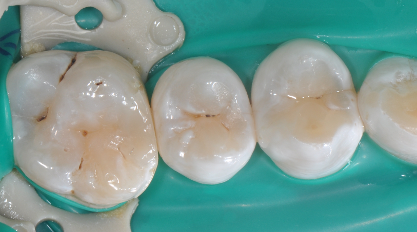 为什么牙医不用开口器特邀牙医【实操病例】集锦{9.22}_https://www.jmylbn.com_新闻资讯_第32张