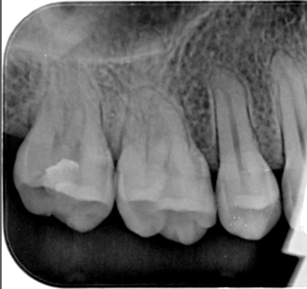 为什么牙医不用开口器特邀牙医【实操病例】集锦{9.22}_https://www.jmylbn.com_新闻资讯_第16张