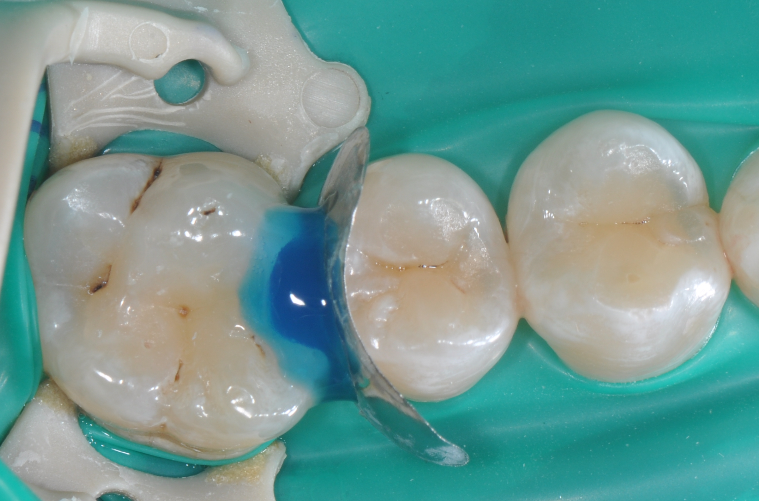 为什么牙医不用开口器特邀牙医【实操病例】集锦{9.22}_https://www.jmylbn.com_新闻资讯_第25张