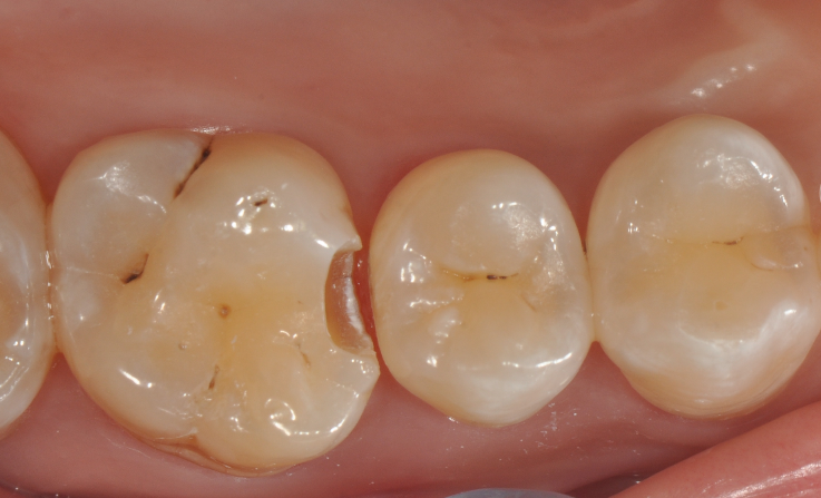 为什么牙医不用开口器特邀牙医【实操病例】集锦{9.22}_https://www.jmylbn.com_新闻资讯_第22张