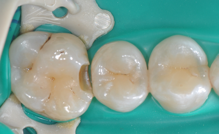 为什么牙医不用开口器特邀牙医【实操病例】集锦{9.22}_https://www.jmylbn.com_新闻资讯_第24张