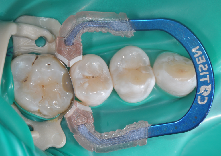 为什么牙医不用开口器特邀牙医【实操病例】集锦{9.22}_https://www.jmylbn.com_新闻资讯_第30张