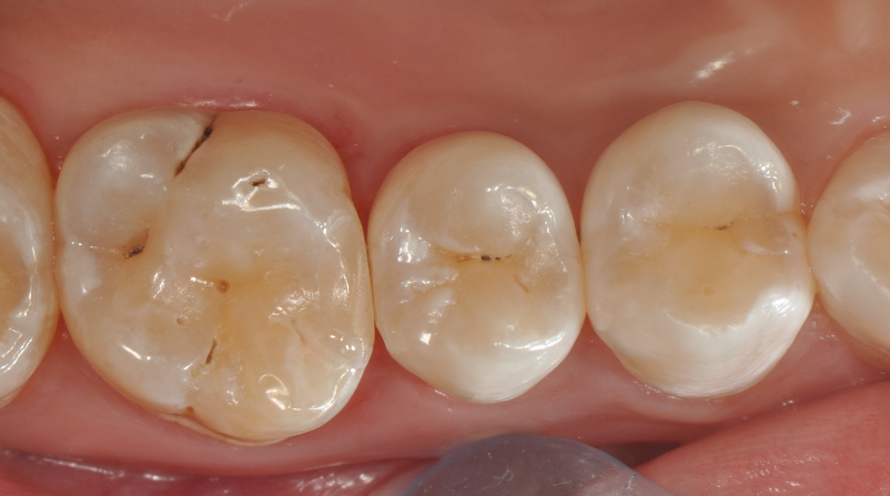 为什么牙医不用开口器特邀牙医【实操病例】集锦{9.22}_https://www.jmylbn.com_新闻资讯_第34张