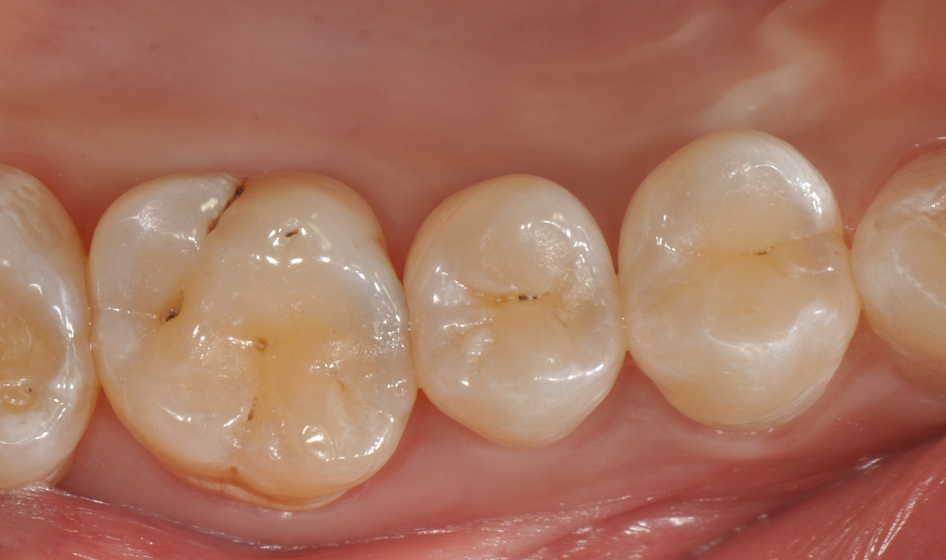 为什么牙医不用开口器特邀牙医【实操病例】集锦{9.22}_https://www.jmylbn.com_新闻资讯_第17张