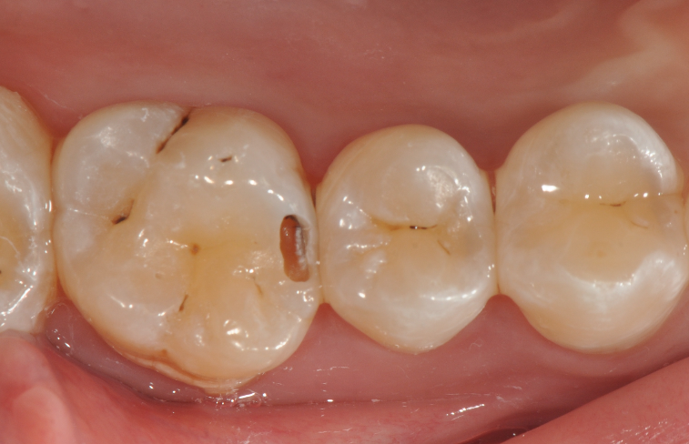 为什么牙医不用开口器特邀牙医【实操病例】集锦{9.22}_https://www.jmylbn.com_新闻资讯_第20张