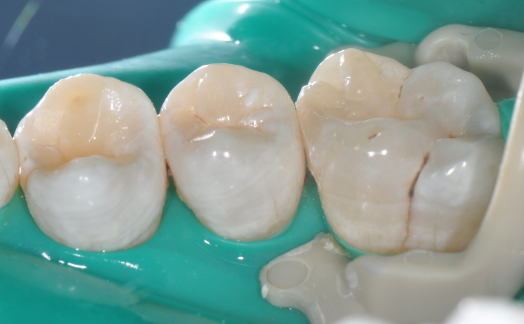 为什么牙医不用开口器特邀牙医【实操病例】集锦{9.22}_https://www.jmylbn.com_新闻资讯_第33张