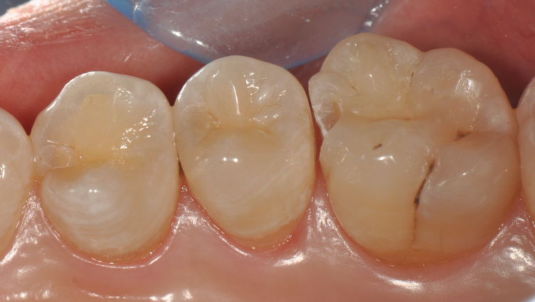 为什么牙医不用开口器特邀牙医【实操病例】集锦{9.22}_https://www.jmylbn.com_新闻资讯_第23张