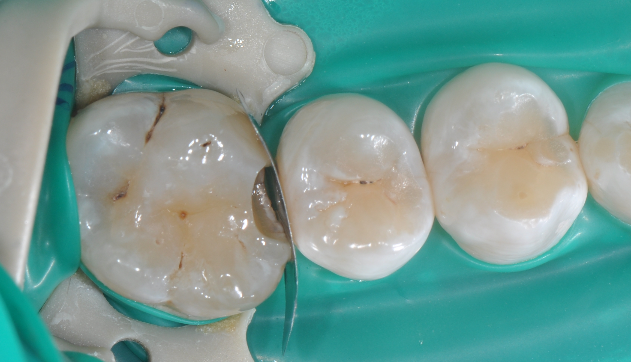 为什么牙医不用开口器特邀牙医【实操病例】集锦{9.22}_https://www.jmylbn.com_新闻资讯_第28张