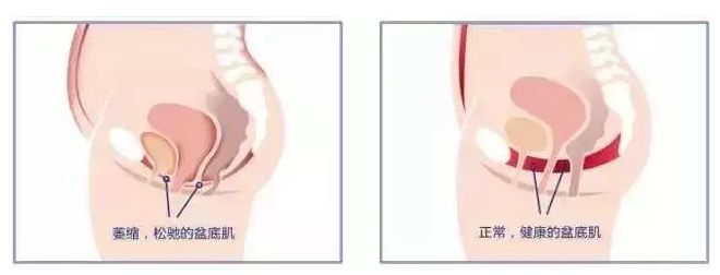 【盆底肌修复】宝妈们不想要“笑尿”，定要了解盆底肌的重要性！