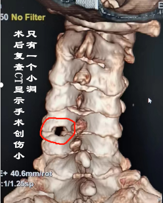 开刀孔怎么开刀技术 ｜ 不开刀用镜子做手术！小小“钥匙孔”解决患者大痛苦_https://www.jmylbn.com_新闻资讯_第10张