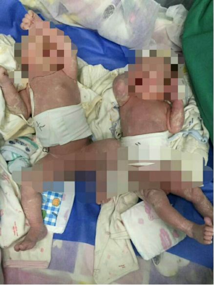 4岁女童患再障，双胞胎弟弟“脐”心合力带来生的希望！