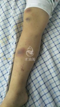 4岁女童患再障，双胞胎弟弟“脐”心合力带来生的希望！