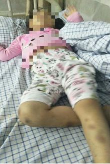 4岁女童患再障，双胞胎弟弟“脐”心合力带来生的希望！