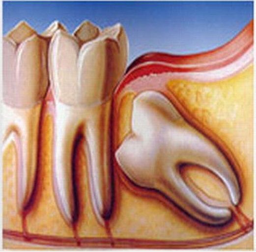 拔智齿真是花钱不讨好的事吗 南宁牙博士口腔正恒门诊部 微信公众号文章阅读 Wemp