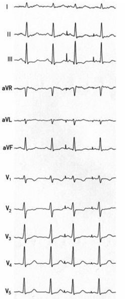 为什么双极不起博心房不同部位起搏，心电图特征一文详解_https://www.jmylbn.com_新闻资讯_第6张