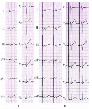为什么双极不起博心房不同部位起搏，心电图特征一文详解_https://www.jmylbn.com_新闻资讯_第13张