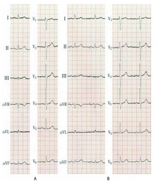 为什么双极不起博心房不同部位起搏，心电图特征一文详解_https://www.jmylbn.com_新闻资讯_第7张