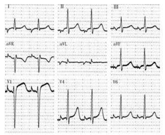 为什么双极不起博心房不同部位起搏，心电图特征一文详解_https://www.jmylbn.com_新闻资讯_第11张