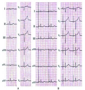 为什么双极不起博心房不同部位起搏，心电图特征一文详解_https://www.jmylbn.com_新闻资讯_第5张