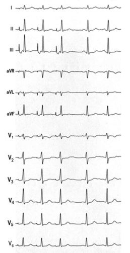 为什么双极不起博心房不同部位起搏，心电图特征一文详解_https://www.jmylbn.com_新闻资讯_第9张