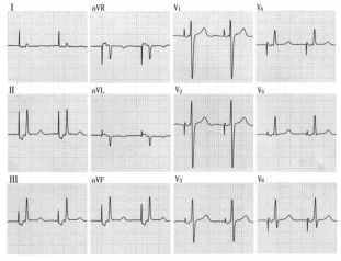 为什么双极不起博心房不同部位起搏，心电图特征一文详解_https://www.jmylbn.com_新闻资讯_第12张