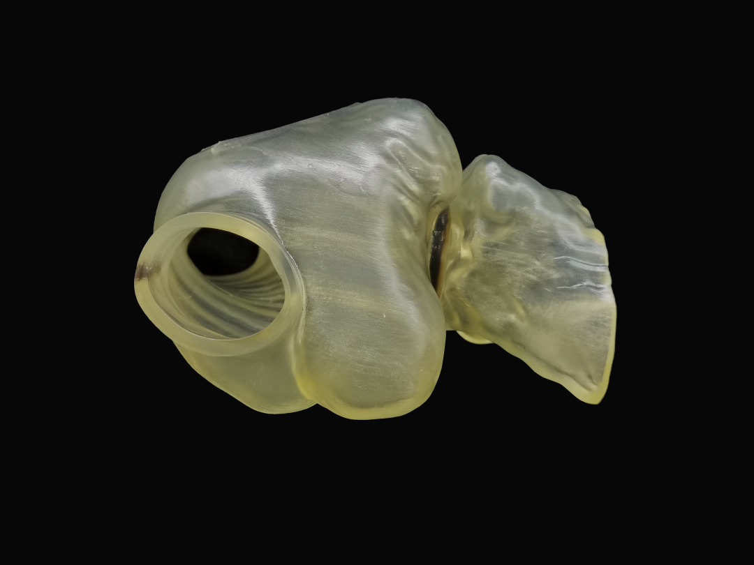 马克医疗精准助力国产球扩瓣经导管"瓣中瓣"治疗三尖瓣生物瓣衰败的