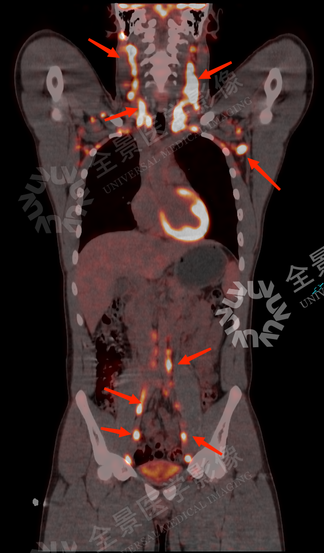 世界淋巴瘤宣传日丨可怕的淋巴瘤，更「青睐」年轻人！