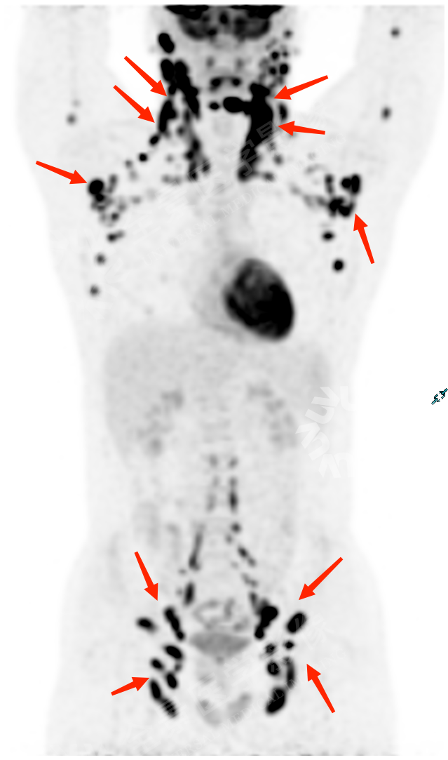 世界淋巴瘤宣传日丨可怕的淋巴瘤，更「青睐」年轻人！