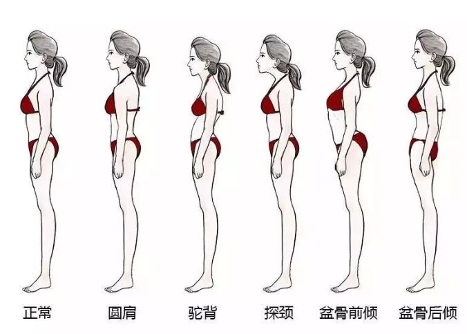 我们时常说的坐姿前倾,骨盆前后倾,驼背,脊柱侧弯,拇外翻,扁平足弓形