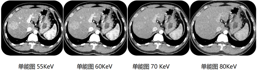 飞利浦都有哪些系列CT设备再升级 ｜ 飞利浦极速ICT，更大程度满足影像检查需求！_https://www.jmylbn.com_新闻资讯_第22张
