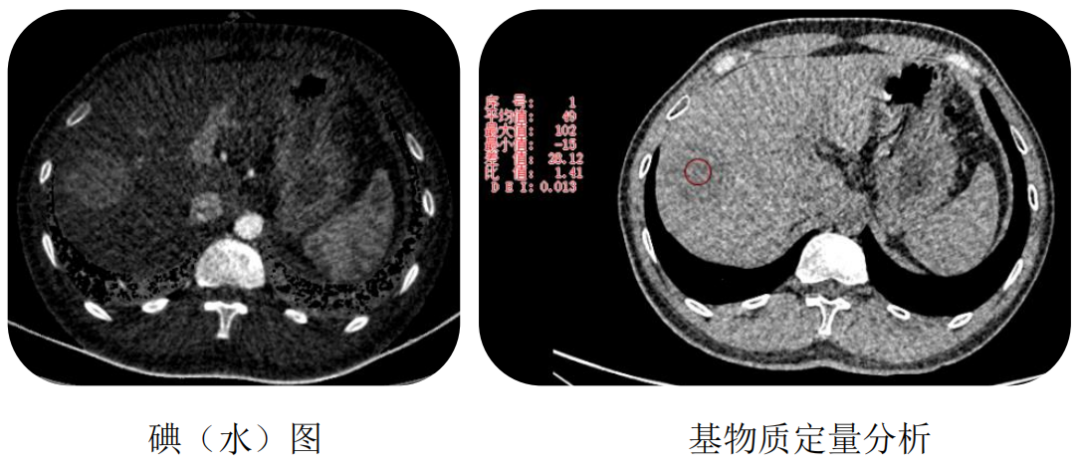飞利浦都有哪些系列CT设备再升级 ｜ 飞利浦极速ICT，更大程度满足影像检查需求！_https://www.jmylbn.com_新闻资讯_第23张