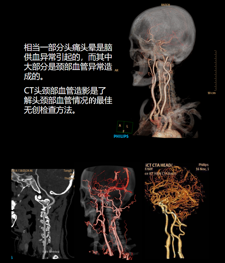 飞利浦都有哪些系列CT设备再升级 ｜ 飞利浦极速ICT，更大程度满足影像检查需求！_https://www.jmylbn.com_新闻资讯_第11张