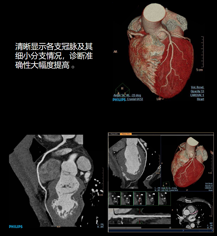飞利浦都有哪些系列CT设备再升级 ｜ 飞利浦极速ICT，更大程度满足影像检查需求！_https://www.jmylbn.com_新闻资讯_第8张
