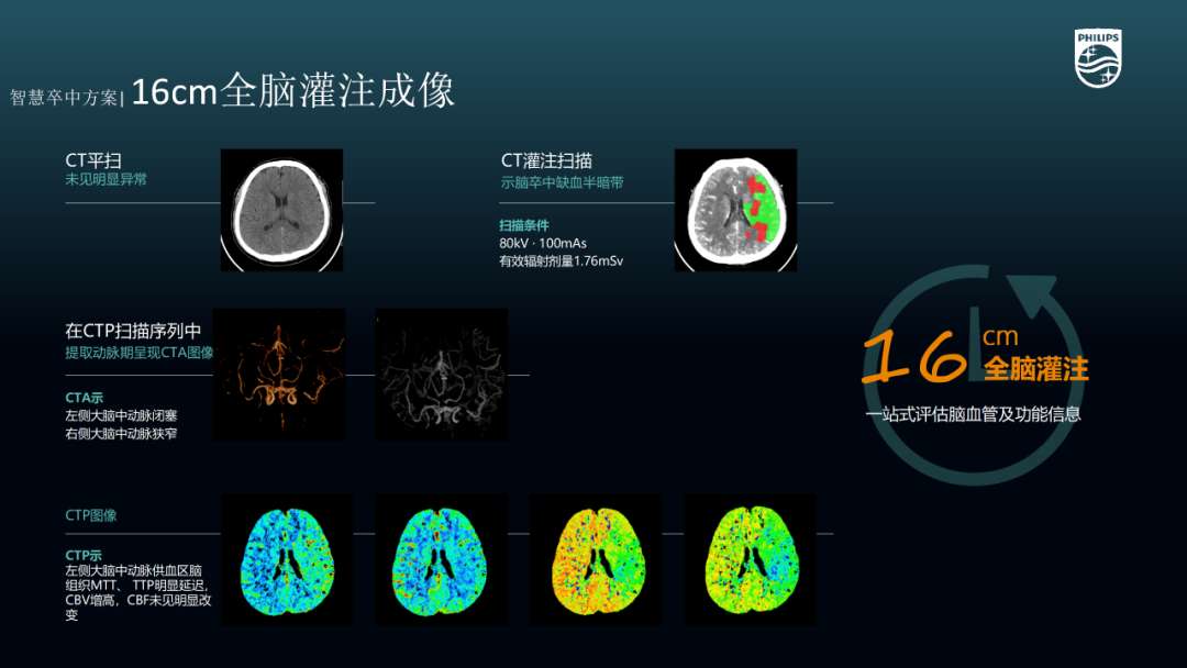 飞利浦都有哪些系列CT设备再升级 ｜ 飞利浦极速ICT，更大程度满足影像检查需求！_https://www.jmylbn.com_新闻资讯_第20张