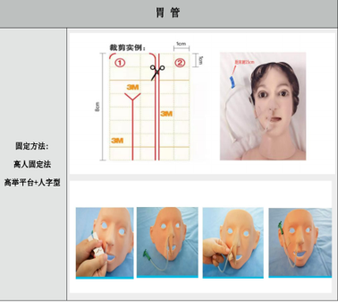 引流管怎么标识常见各类管道护理规范（评估、标识及固定）_https://www.jmylbn.com_新闻资讯_第4张