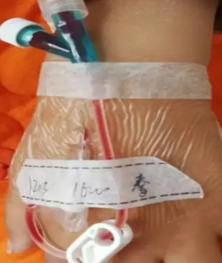 为什么叫正压留置针的留置针堵管了，拔针还是强行冲管？_https://www.jmylbn.com_新闻资讯_第2张