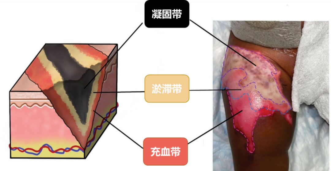创面修复抗菌敷料怎么用走进创面修复：不同深度和治疗阶段的烧伤创面如何选择敷料？_https://www.jmylbn.com_新闻资讯_第5张