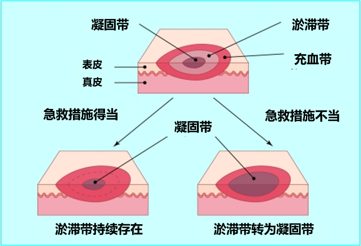 创面修复抗菌敷料怎么用走进创面修复：不同深度和治疗阶段的烧伤创面如何选择敷料？_https://www.jmylbn.com_新闻资讯_第6张