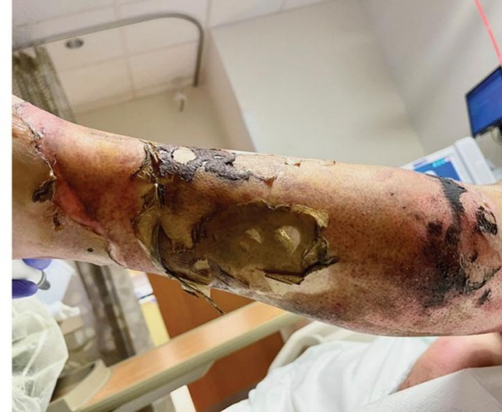 创面修复抗菌敷料怎么用走进创面修复：不同深度和治疗阶段的烧伤创面如何选择敷料？_https://www.jmylbn.com_新闻资讯_第4张