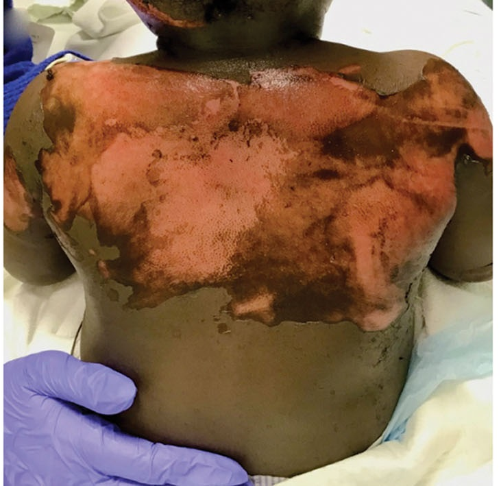 创面修复抗菌敷料怎么用走进创面修复：不同深度和治疗阶段的烧伤创面如何选择敷料？_https://www.jmylbn.com_新闻资讯_第3张